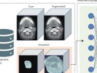 人工智能算法或有助于更好地指导口咽癌治疗