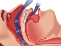危险的打鼾可能会影响五分之一的人但大多数患者并不知道自己有问题