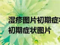 湿疹图片初期症状图片荨麻疹图片 湿疹图片初期症状图片 