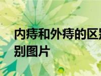 内痔和外痔的区别图片大全 内痔和外痔的区别图片 