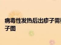 病毒性发热后出疹子需要进行皮肤治疗吗 病毒性发烧后出疹子图 