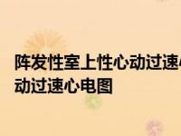 阵发性室上性心动过速心电图表现正确的是 阵发性室上性心动过速心电图 