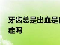 牙齿总是出血是白血病吗 牙齿总是出血是癌症吗 